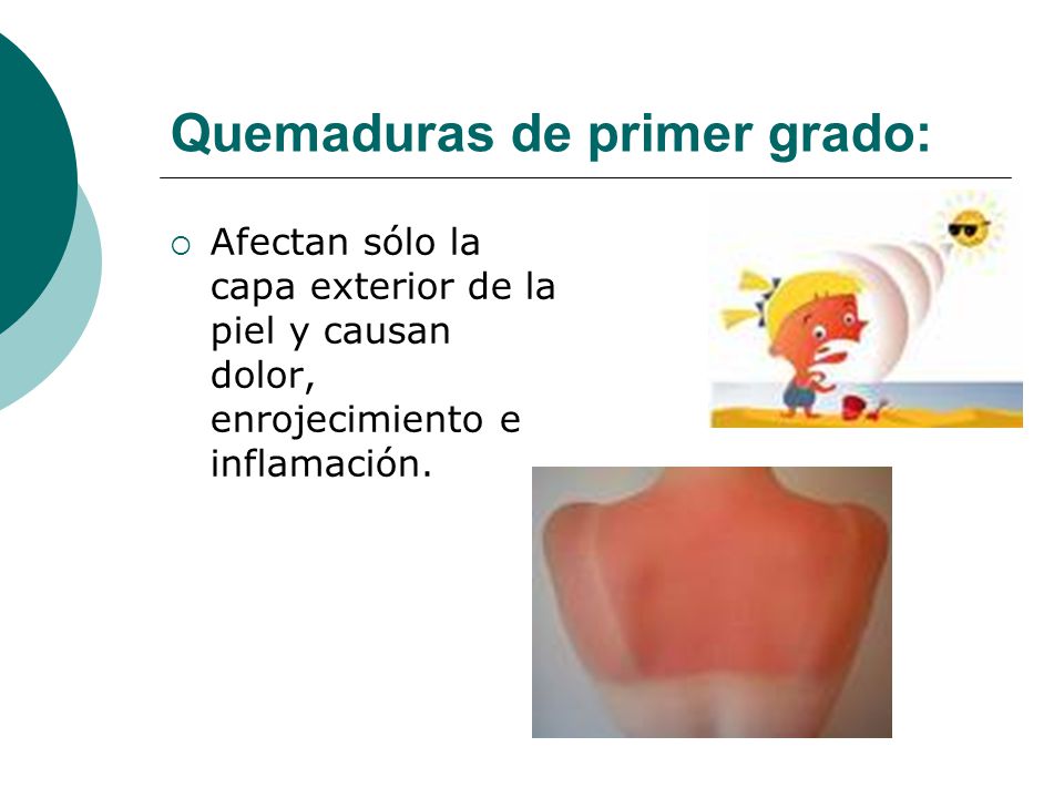 Como prevenir quemaduras de primer grado